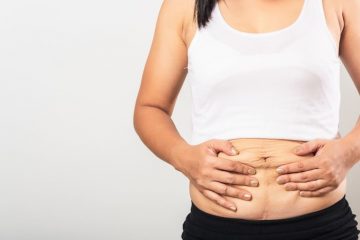 How to reduce scarring after Gastric Sleeve surgery